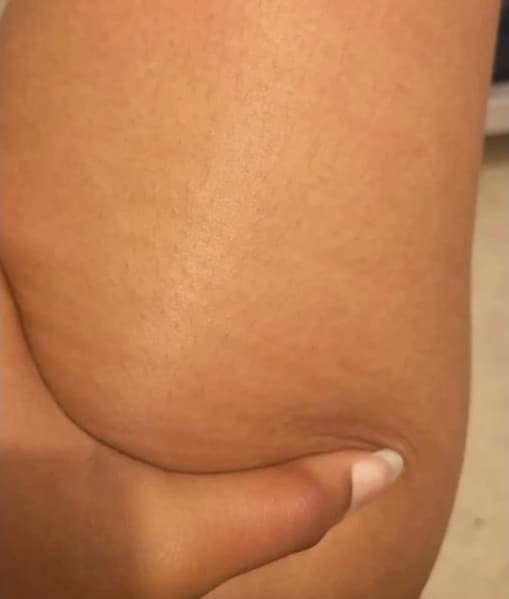 3 weeks after percussion therapy cellulite